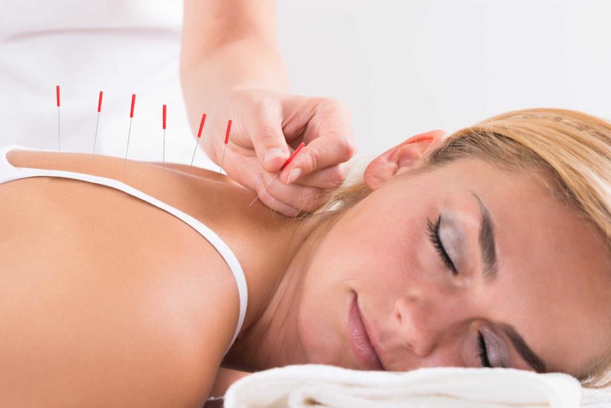 Dry Needle Therapy 862x575 1
