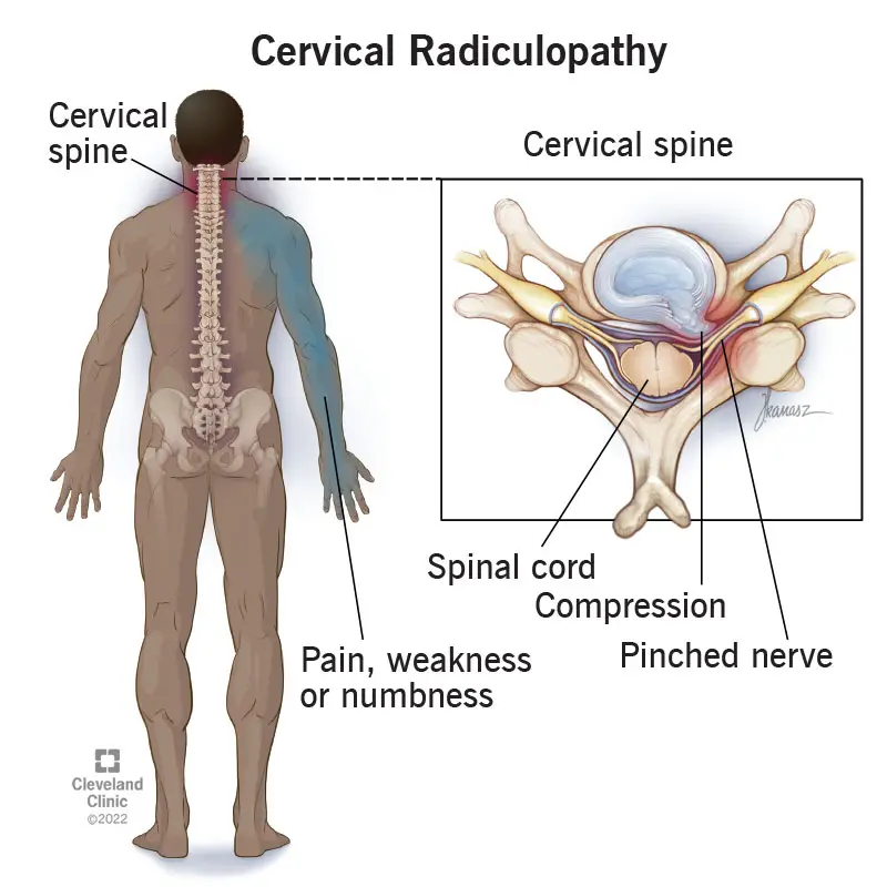 The Role of Physical Therapy in Treating Cervical Radiculopathy: What You Need to Know in 1 post 1 22639 cervical radiculopathy