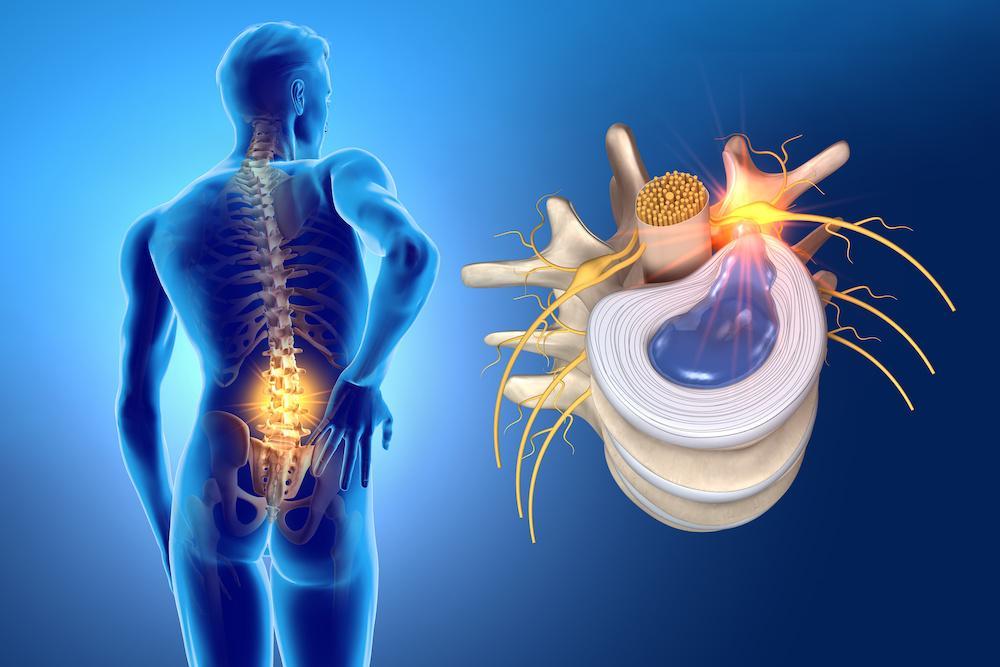 The Latest Advances in Disc Herniation Surgery: What You Need to Know 1 The Latest Advances in Disc Herniation Surgery: What You Need to Know at lahore Spine Care