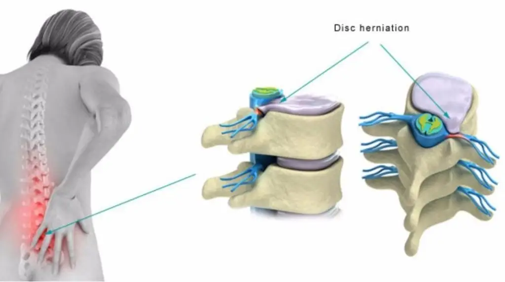 Disc Protrusion and low back pain