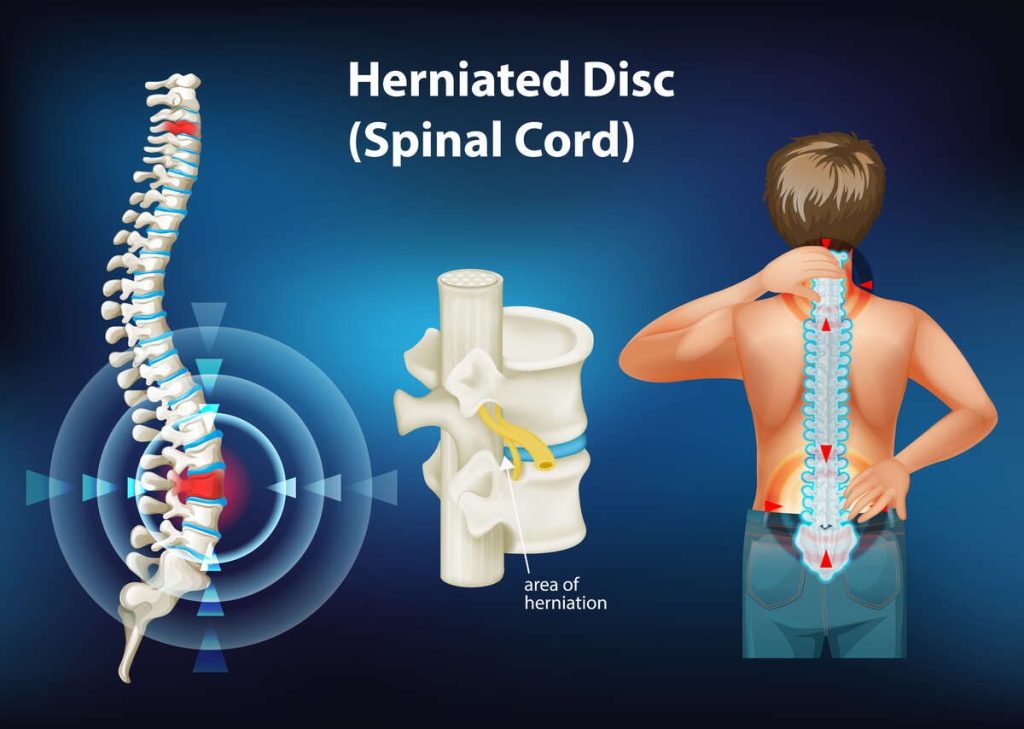 Disc Herniation
