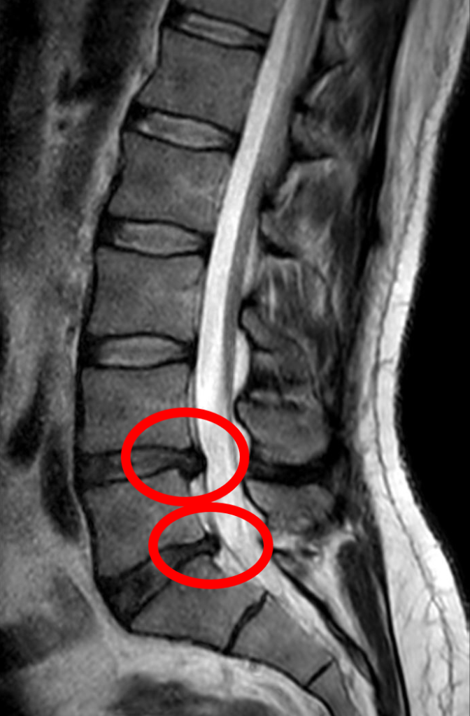 Living with disc herniation: strategies for daily life and pain management 5 Hernie discale L4 L5 1