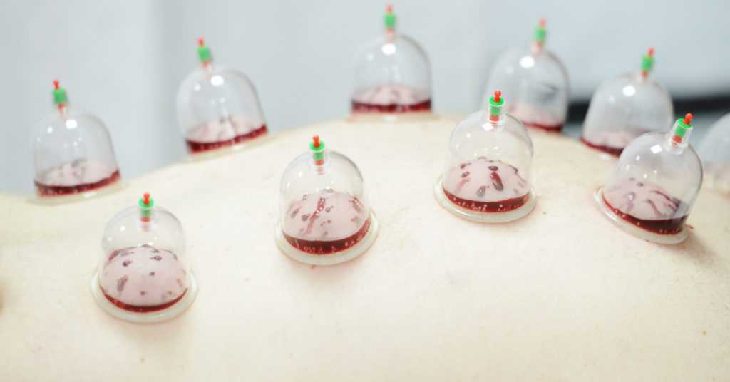 Hijama Benefits 1 1024x536 1