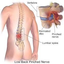 Untreated Disc Herniation: