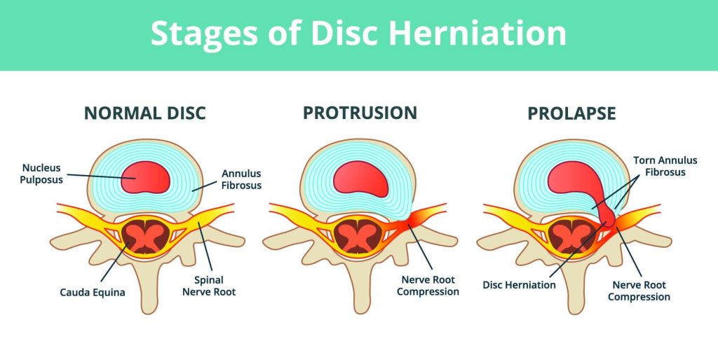 Disc Bulge