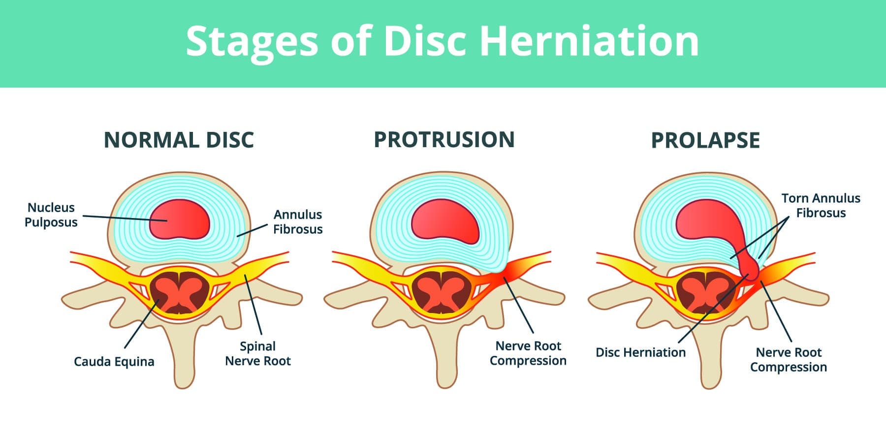 How to Diagnose Disc Bulge: Causes, Symptoms, and Treatment 8 Disc Bulge