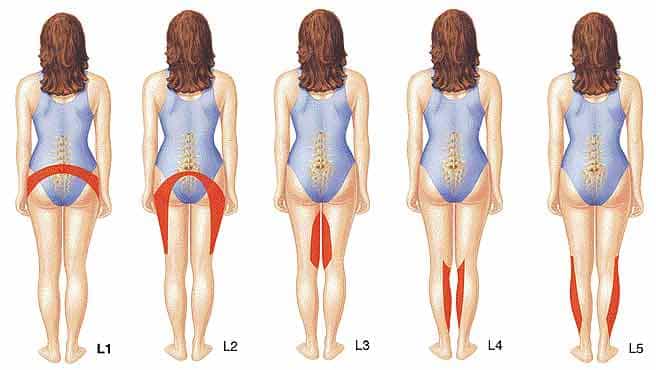 disc bulge dermototmes