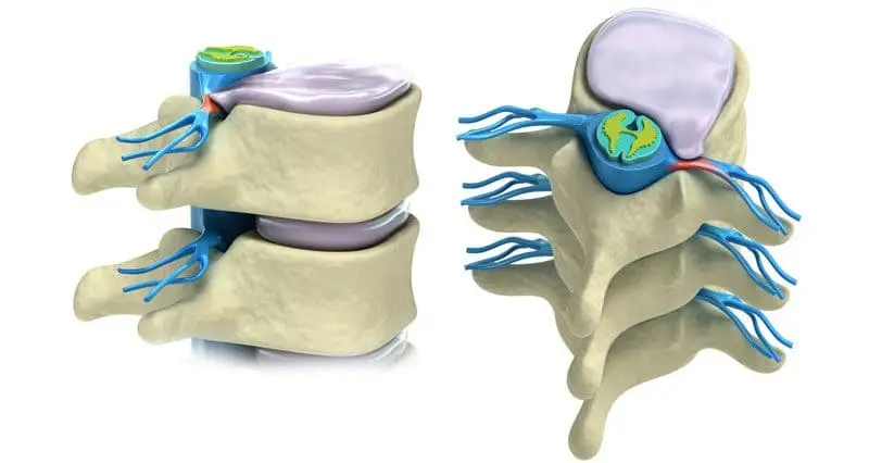 slipped disc800 800x426 1