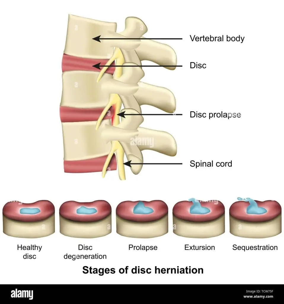 stages of disc herniation spine and disc anatomy 3d medical vector illustration eps 10 TCW75F 1